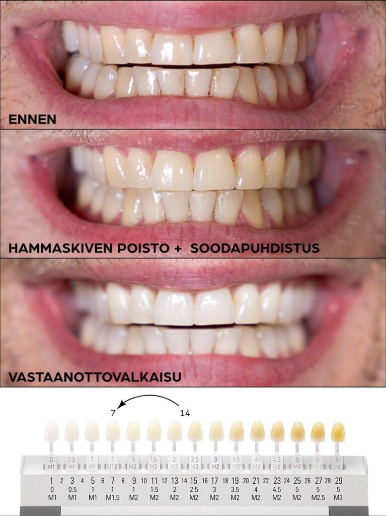 Hoitotulos: hammaskivenpoisto, soodapuhdistus ja vastaanottovalkaisu.