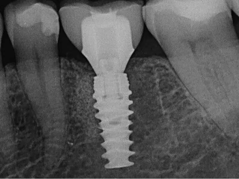 Hammasimplantti röntgenkuvassa