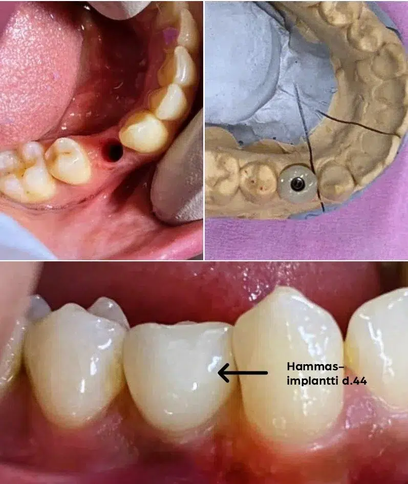 Immediaatti-implantin asennus poistoaukkoon