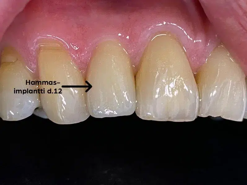 Hammasimplantti implanttikruunulla, esimerkki tuloksesta