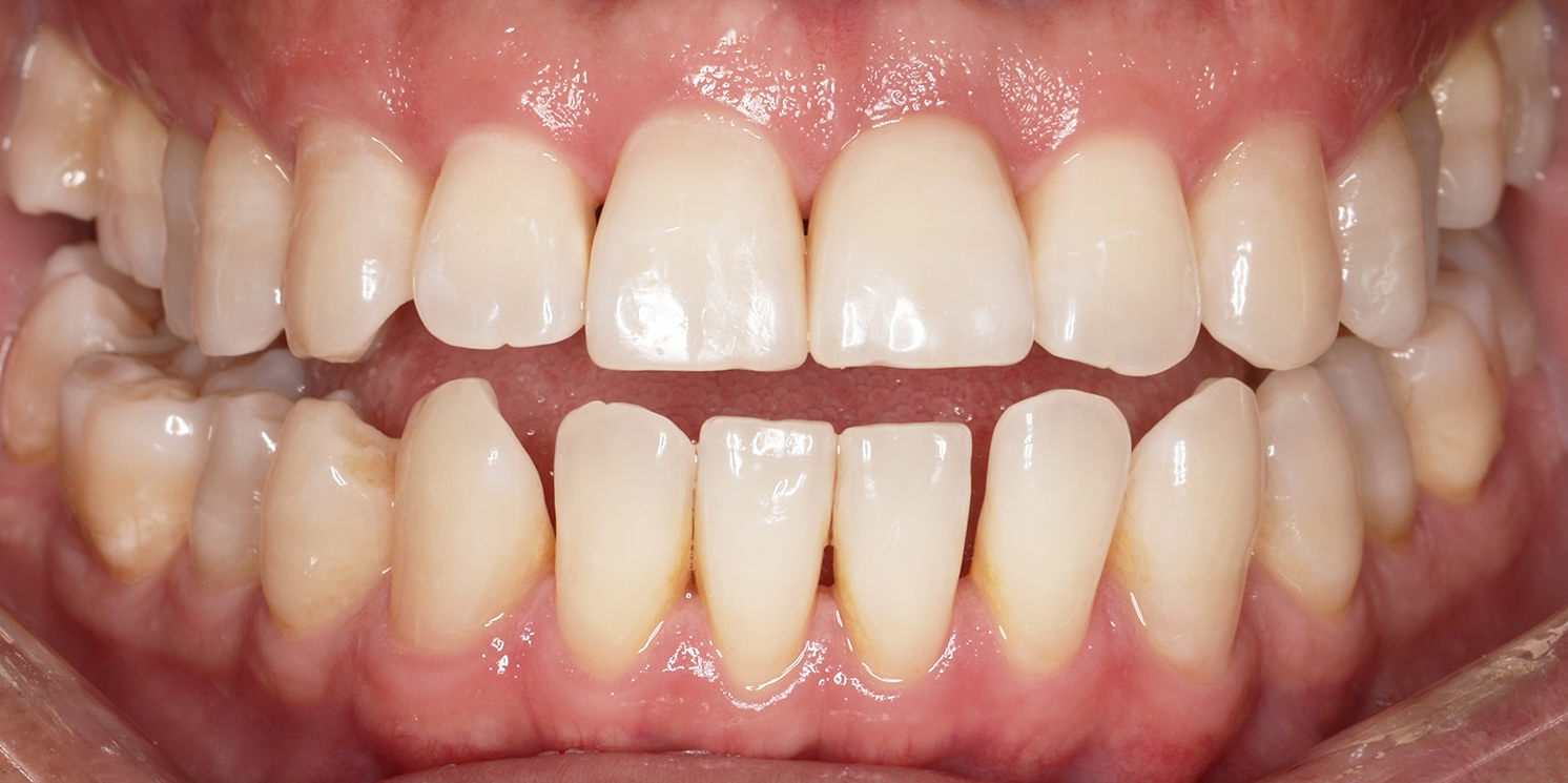 Hammasimplantti hoitotulos jälkeen-kuva